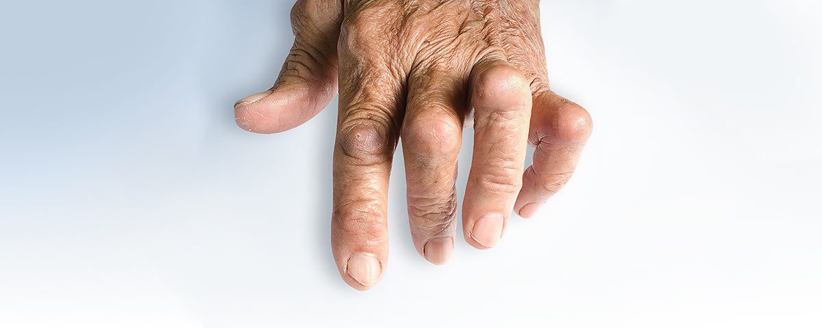 Psoriatic Arthritis – Pathophysiology 101